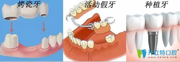 牙齒缺失10后還能做種植牙和烤瓷牙及活動假牙嗎
