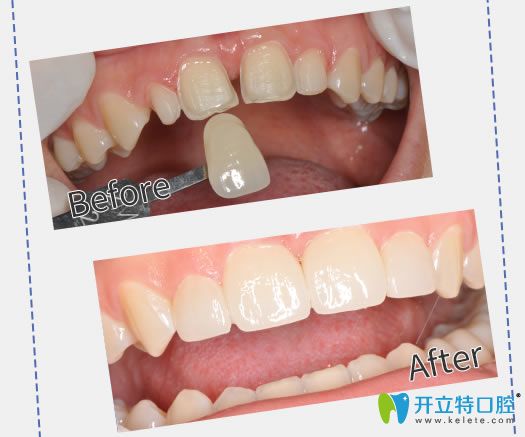 廣州圣貝口腔蔡菁菁醫(yī)生牙齒貼面案例
