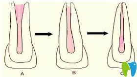 解答什么叫根尖誘導(dǎo)成形術(shù),及兒童做牙根尖誘導(dǎo)是否有風(fēng)險