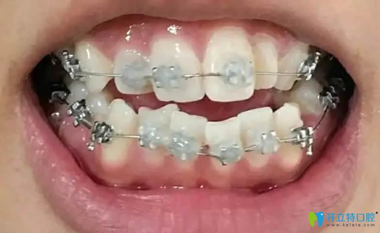 真心覺得在長(zhǎng)春欣雅口腔做的牙齒矯正價(jià)格不貴且效果好