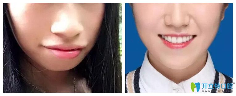 牙齒正畸對臉型的影響？看牙齒矯正案例效果前后對比圖