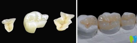 嵌體補(bǔ)牙3300貴不貴?透露同樣是補(bǔ)牙為什么嵌體要貴10倍以上