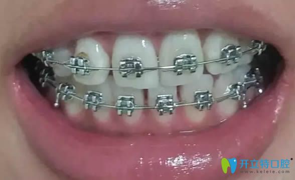 在長春欣雅口腔戴金屬牙套11個月照