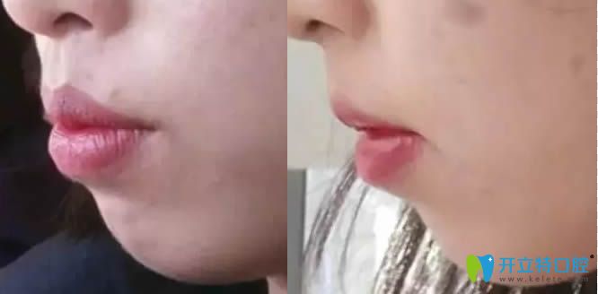 在欣雅口腔做牙齒矯正的側(cè)顏對比照