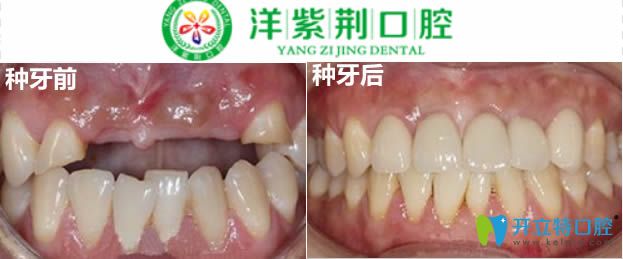 4顆門(mén)牙缺失種植修復(fù)案例圖