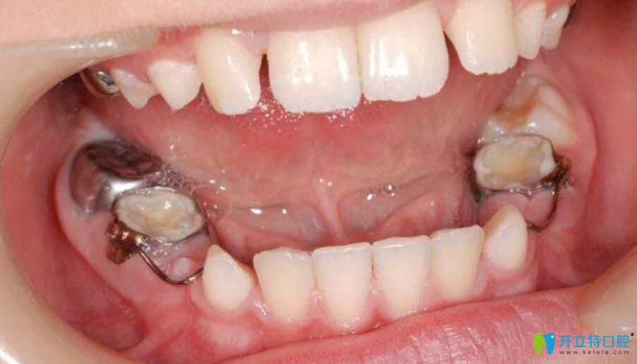 兒童間歇保持器是什么