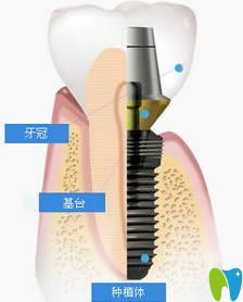 瑞士iti和瑞典諾貝爾種植牙哪個好