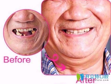 北京中諾種植牙怎么樣？郭晨剛種植牙案例來揭曉