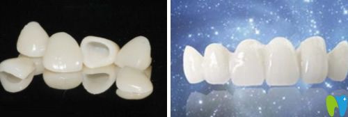 網(wǎng)上說(shuō)做了全瓷牙好后悔是真的嗎?來(lái)聽(tīng)聽(tīng)做全瓷牙人的經(jīng)歷