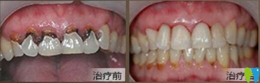 北京中諾口腔好不好？郭祖迎牙齒修復(fù)案例效果來驗(yàn)證