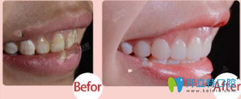北京中諾口腔牙貼面治療黃牙案例