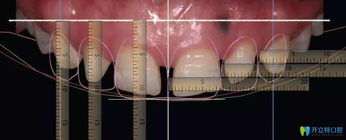 為什么要做牙冠延長術(shù)？揭秘做牙冠延長術(shù)后悔死了的真相