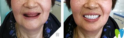 杭州美奧口腔全口種植牙案例