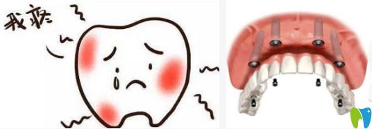 究竟做種植牙疼不疼/術后大概疼幾天？聽資深醫(yī)生親自回答