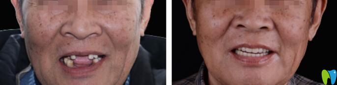 青島種植牙哪家比較好？維樂(lè)口腔梁騰種植牙案例來(lái)證明