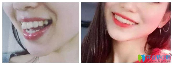 牙齒矯正能改變臉型嗎？看維樂口腔<!--<i data=20240703-sp></i>-->齙牙矯正前后對比圖