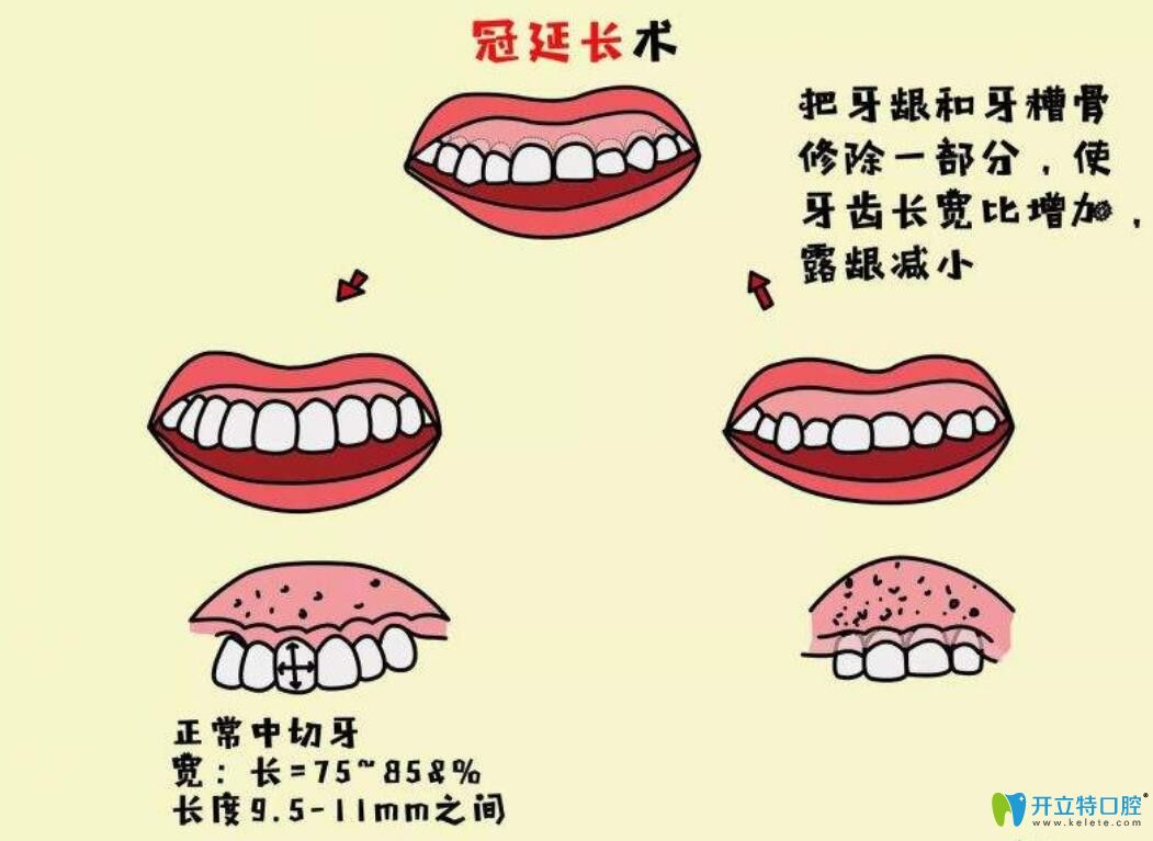 牙冠延長術(shù)是什么，有什么作用