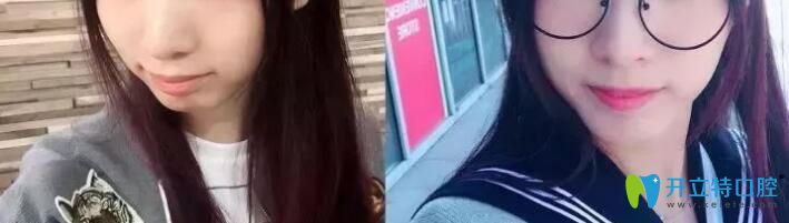 青島維樂(lè)口腔梁騰怎么樣？牙齒矯正案例效果來(lái)揭曉