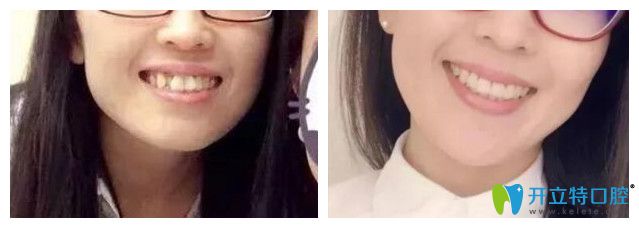 青島維樂口腔<!--<i data=20240703-sp></i>-->牙齒矯正怎么樣？案例效果來驗證