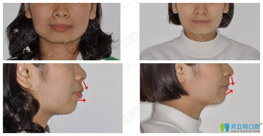 圣貝口腔正畸怎么樣？來(lái)看熊飛突嘴齙牙矯正案例前后效果對(duì)比