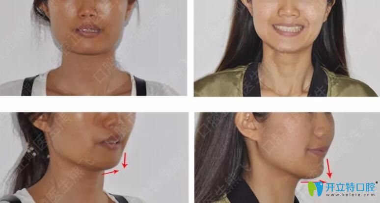 廣州圣貝口腔怎么樣？公布熊飛等醫(yī)生牙齒矯正案例