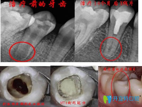 年輕恒牙牙髓再生術治療效果圖