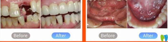 北京中諾口腔鄭宏光種植牙怎么樣？真人案例來揭曉