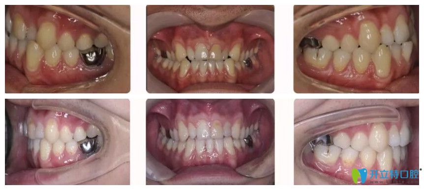 福州哪里整牙比較好？看福州維樂口腔郭淑蘋地包天矯正案例效果圖