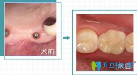 福州哪家種植牙好？維樂口腔陳獻禮院長即刻種植案例來驗證