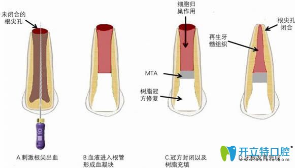 牙髓血管再生術治療過程圖解