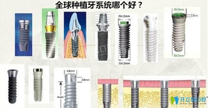 種植牙系統(tǒng)哪個好？來看世界種植體排名詳情及價格表
