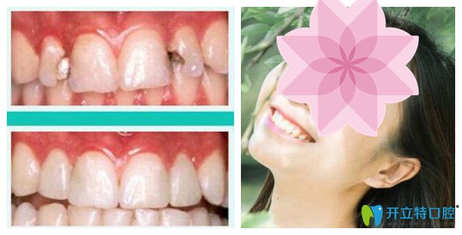 北京中諾口腔張勝民牙齒修復(fù)怎么樣？真實(shí)案例效果公布