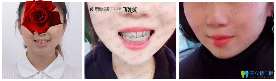 重慶成佳牙博士怎么樣，坑人嗎？看牙博士口腔醫(yī)生矯正真人案例