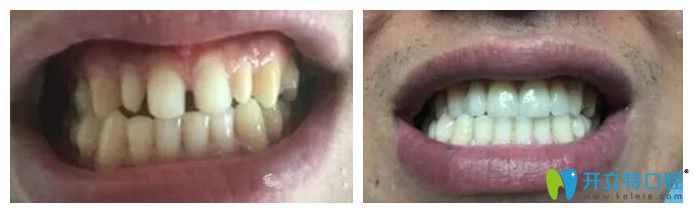 北京中諾口腔劉曉清怎么樣？來看瓷貼面修復(fù)牙齒案例效果