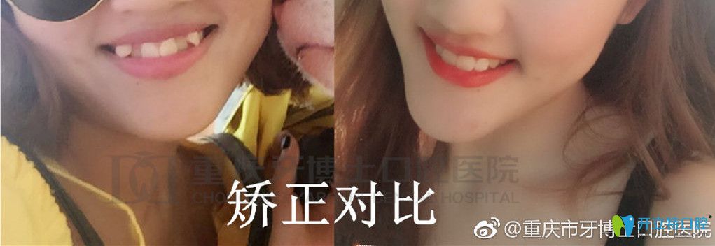 重慶牙博士正畸對比圖