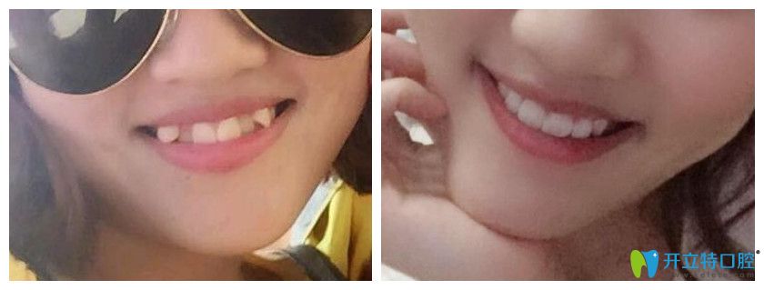 有虎牙能做矯正嗎？看重慶牙博士口腔虎牙隱形矯正案例效果對比圖