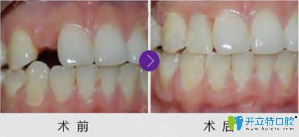 洛陽(yáng)拜博口腔單顆牙缺失種植牙前后對(duì)比效果 洛陽(yáng)拜博口腔單顆牙缺失種植牙前后對(duì)比效果