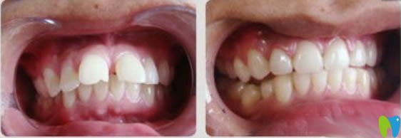隱適美齙牙矯正前后對(duì)比圖 隱適美齙牙矯正前后對(duì)比圖
