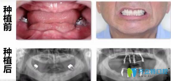洛陽(yáng)拜博口腔全口牙缺失即刻種植案例圖
