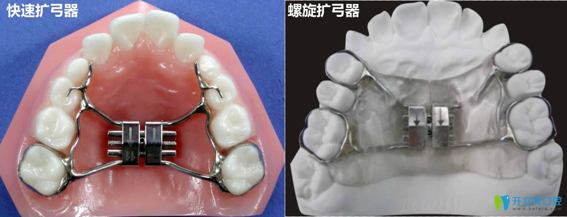 揭開(kāi)牙齒擴(kuò)弓后非常后悔的真相 其實(shí)拔牙和擴(kuò)弓各有利弊
