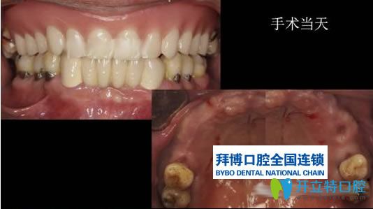 楊小林醫(yī)生無(wú)牙頜種植病例前后對(duì)比效果