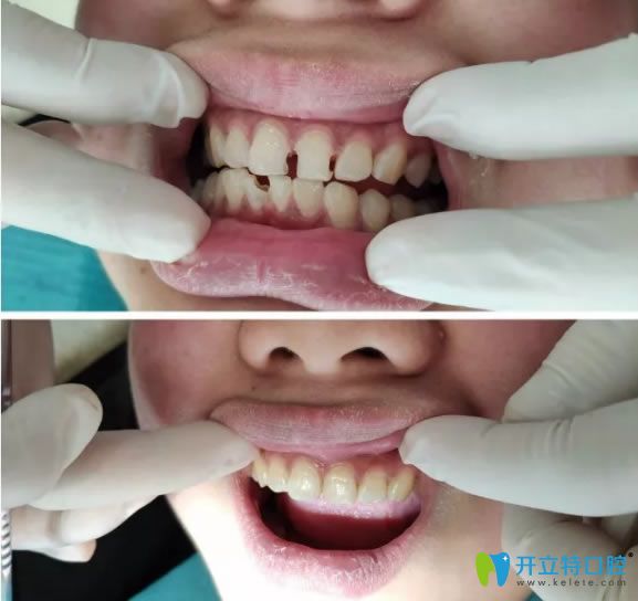 洛陽(yáng)拜博口腔謝良雄醫(yī)生治療案例前后對(duì)比圖