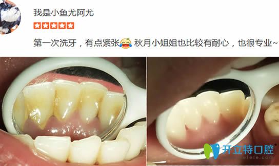 顧客在洛陽拜博洗牙前后對比效果圖