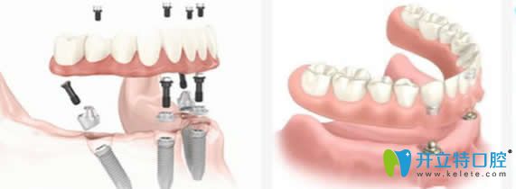 湛江致美口腔ALL-ON-4種植牙技術(shù)