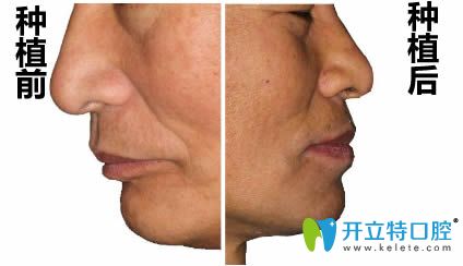 在洛陽拜博做完即刻種植牙前后對(duì)比照