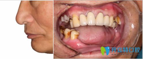 我去洛陽拜博做即刻種植牙已經(jīng)1年了,分享下個(gè)人經(jīng)歷及感受