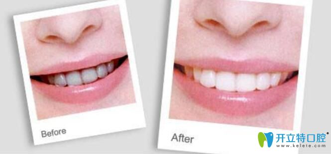 牙齒噴砂和拋光區(qū)別是什么，哪個(gè)好