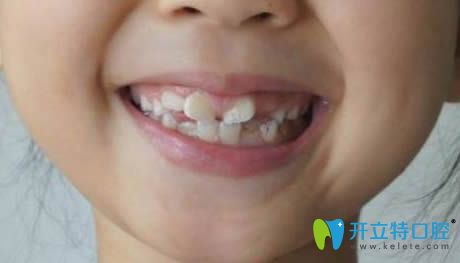 小孩新?lián)Q的恒牙長(zhǎng)歪了怎么辦?恒牙長(zhǎng)歪會(huì)自動(dòng)調(diào)整歸位嗎?