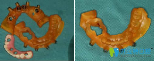  術(shù)中使用的導(dǎo)板