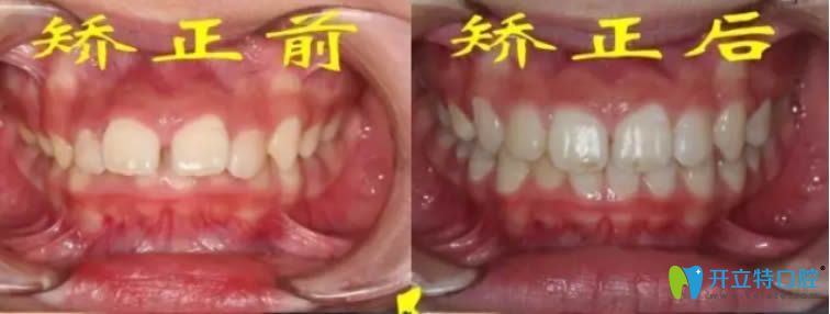洛陽拜博畢芳醫(yī)生MRC矯正案例對比照
